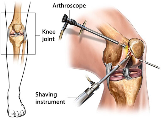 ARTHROSCOPY SURGERY IN PANVEL
