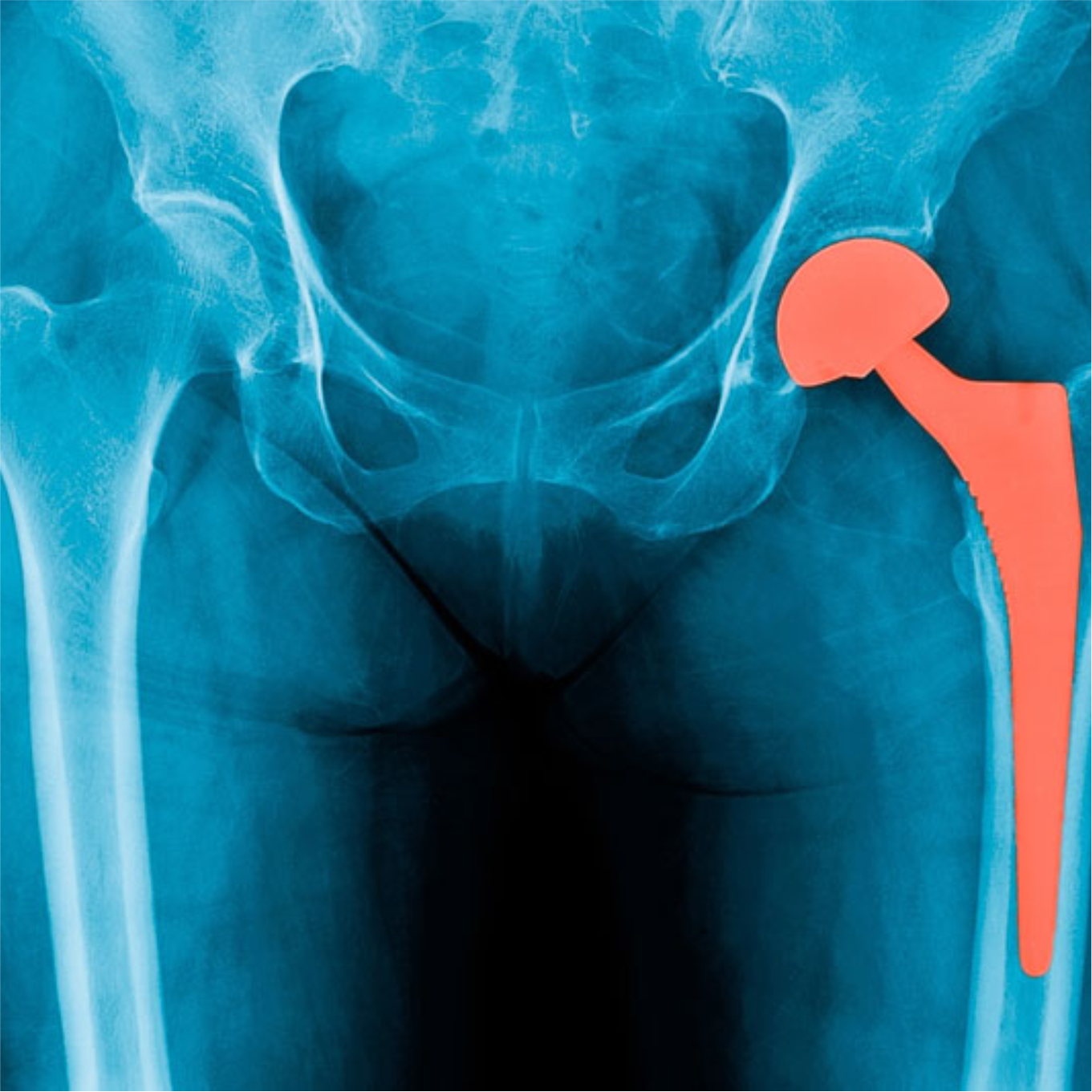 joint replacement clinic